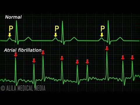 Atrial Fibrillation Anatomy, ECG and Stroke, Animation
